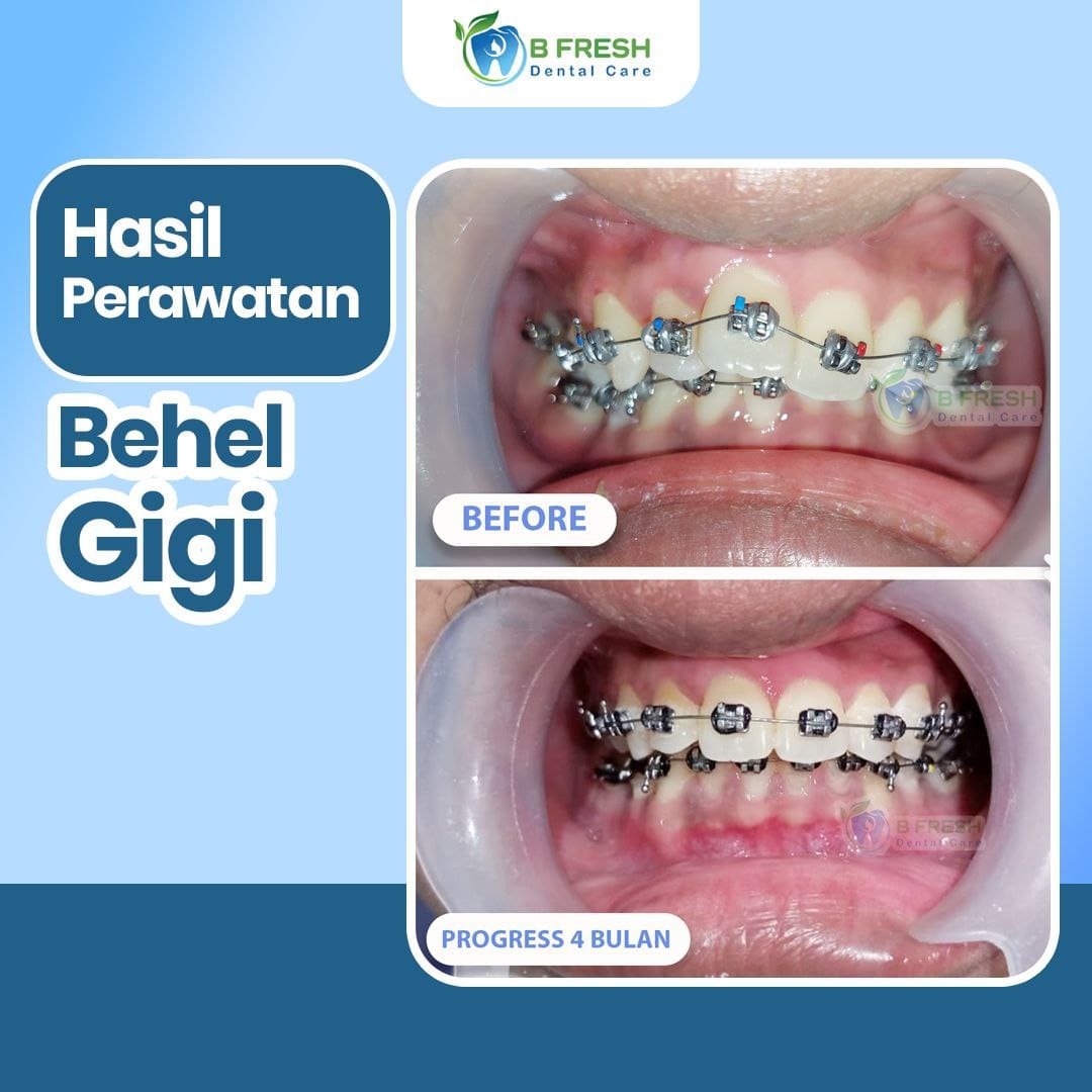 Behel Gigi #1 — hasil perawatan kasus 2 di B Fresh Dental Care