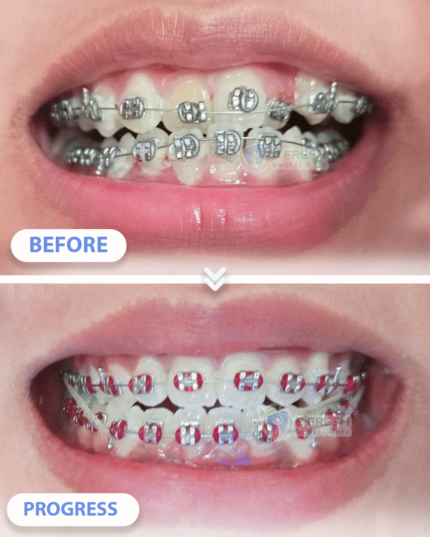 Behel Gigi #11 — hasil perawatan kasus 2 di B Fresh Dental Care