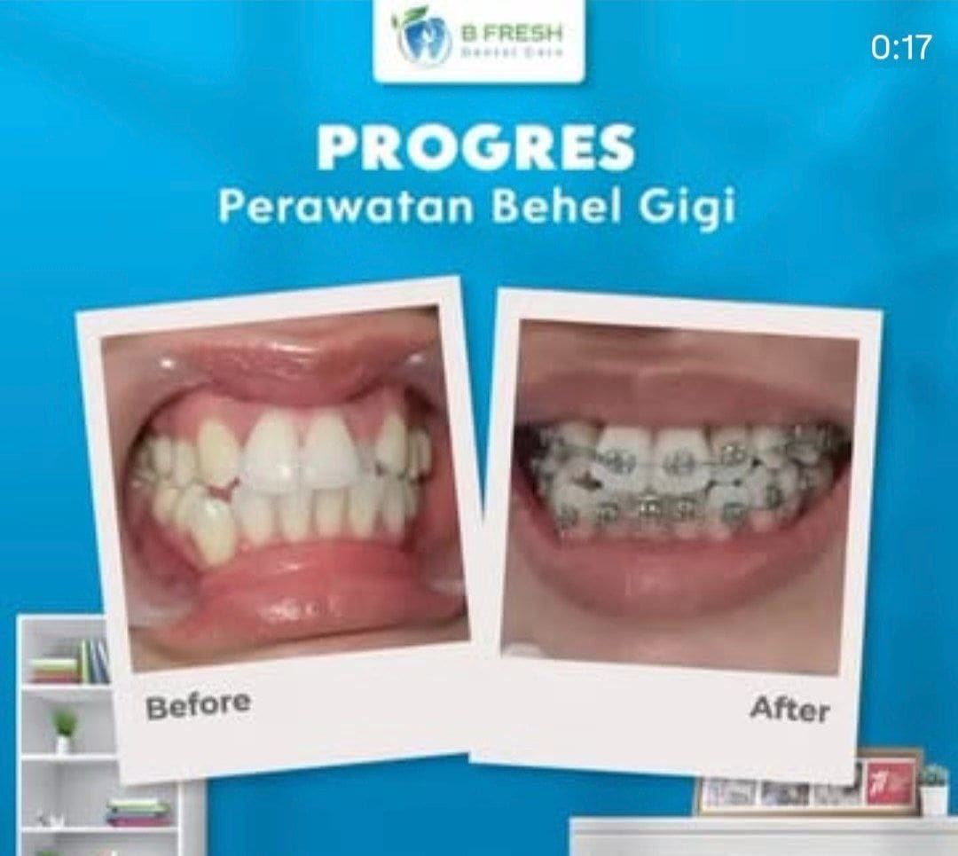 Behel Gigi #14 — hasil perawatan B Fresh Dental Care