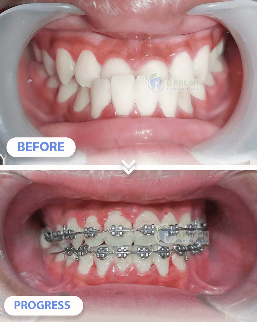Behel Gigi #2 — hasil perawatan B Fresh Dental Care