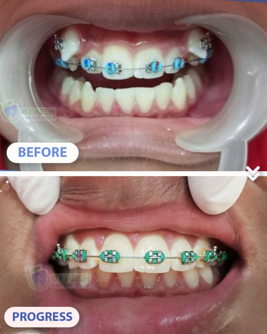 Behel Gigi #2 — hasil perawatan kasus 2 di B Fresh Dental Care
