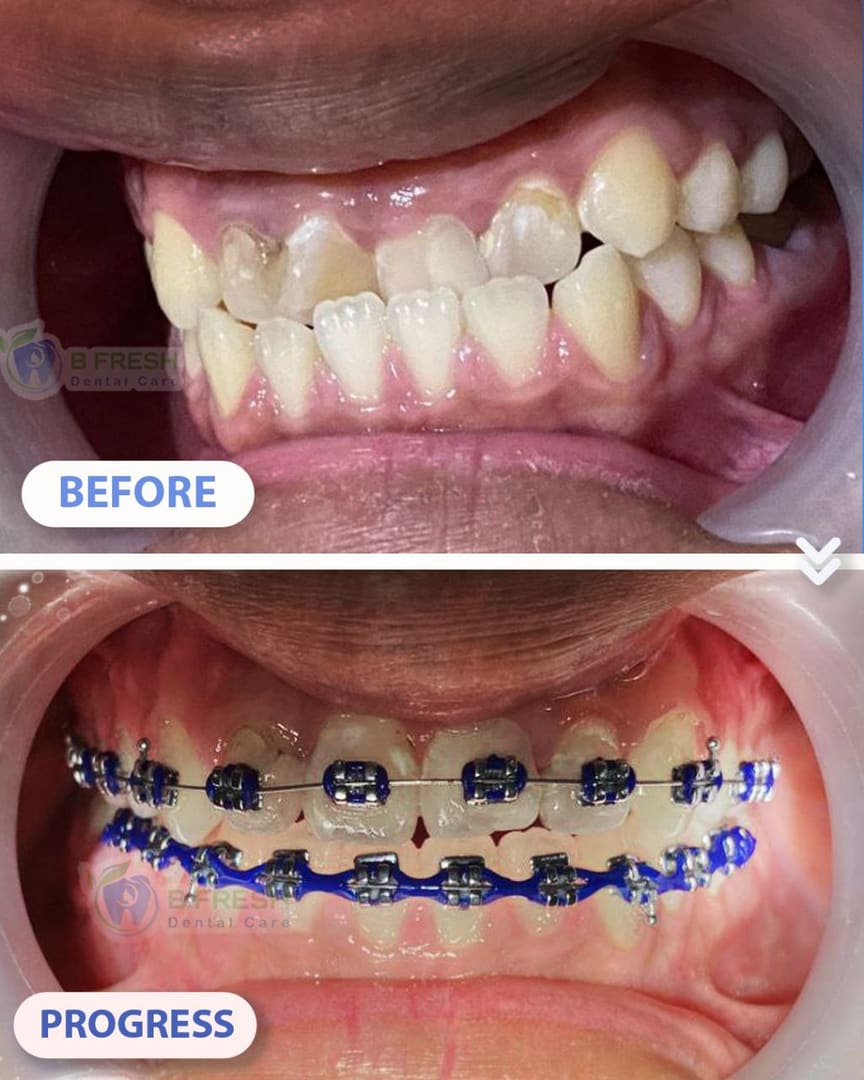 Behel Gigi #5 — hasil perawatan kasus 3 di B Fresh Dental Care