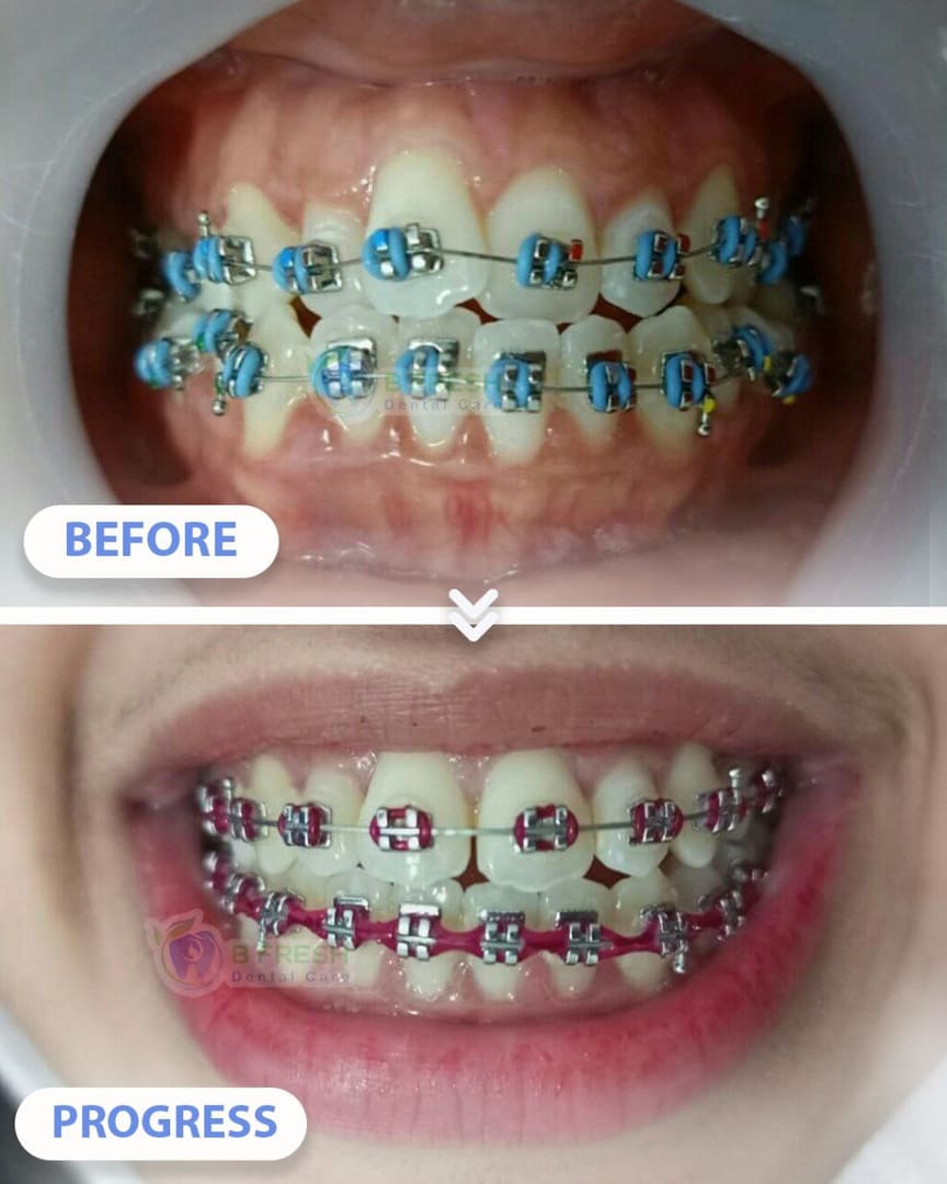 Behel Gigi #6 — hasil perawatan kasus 1 di B Fresh Dental Care