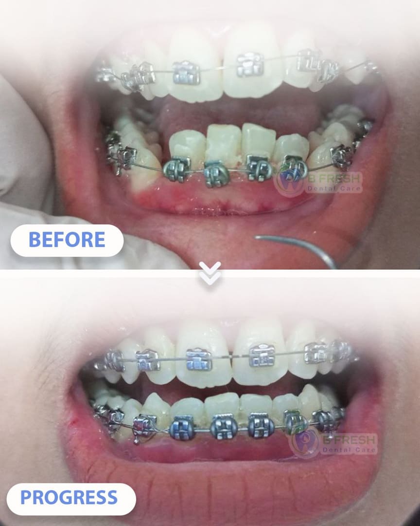Behel Gigi #6 — hasil perawatan kasus 3 di B Fresh Dental Care