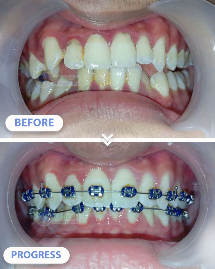 Behel Gigi #7 — hasil perawatan kasus 1 di B Fresh Dental Care