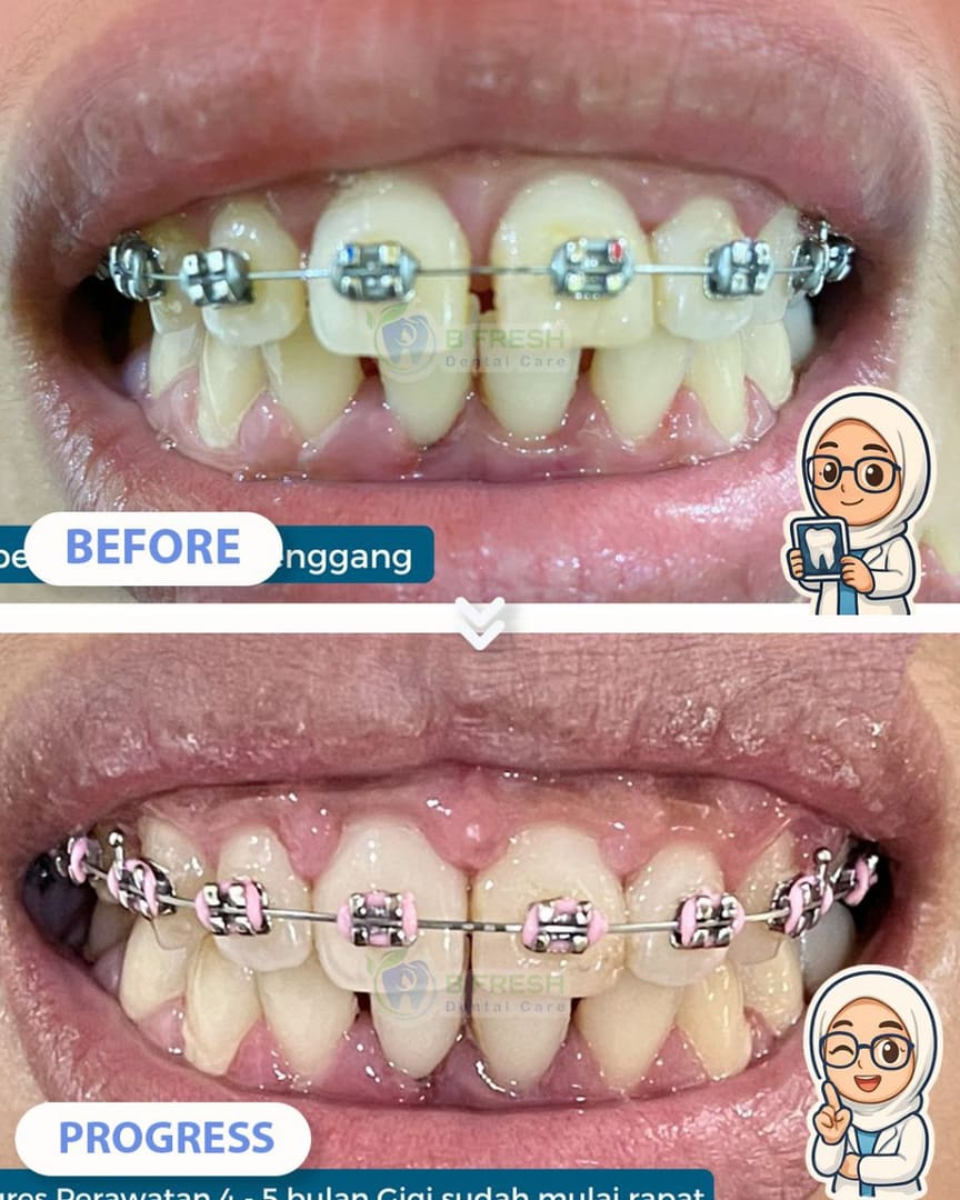 Behel Gigi #7 — hasil perawatan kasus 3 di B Fresh Dental Care