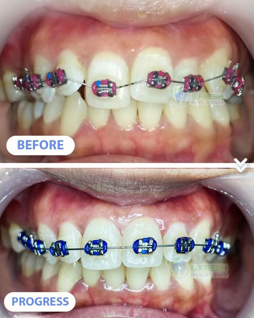 Behel Gigi #9 — hasil perawatan kasus 3 di B Fresh Dental Care