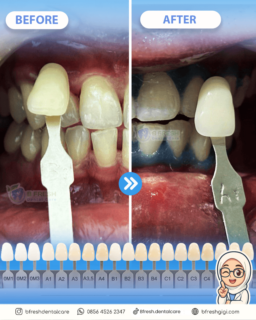 Bleaching #3 — hasil perawatan B Fresh Dental Care
