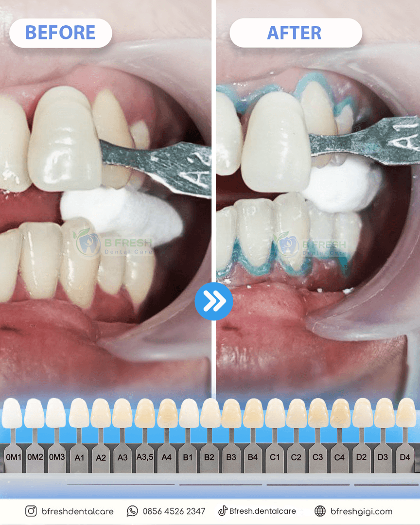 Bleaching #3 — hasil perawatan kasus 2 di B Fresh Dental Care