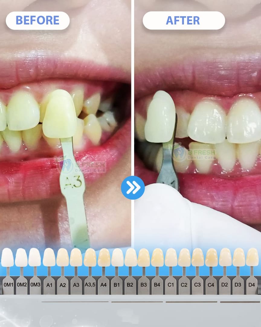 Bleaching #3 — hasil perawatan kasus 3 di B Fresh Dental Care