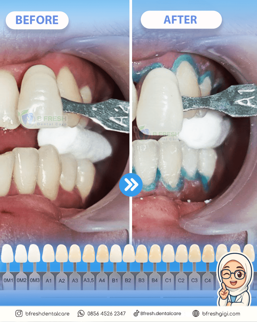 Bleaching #5 — hasil perawatan B Fresh Dental Care