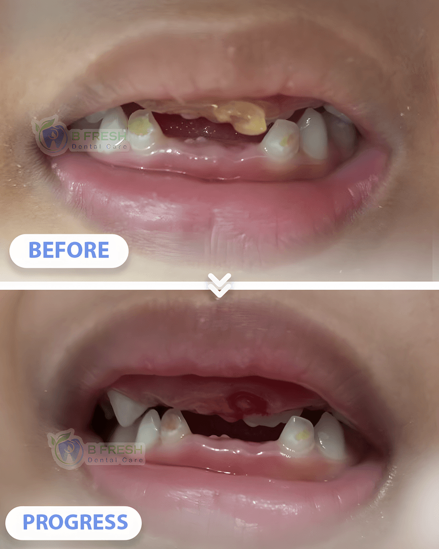 Cabut Gigi Anak #2 — hasil perawatan B Fresh Dental Care