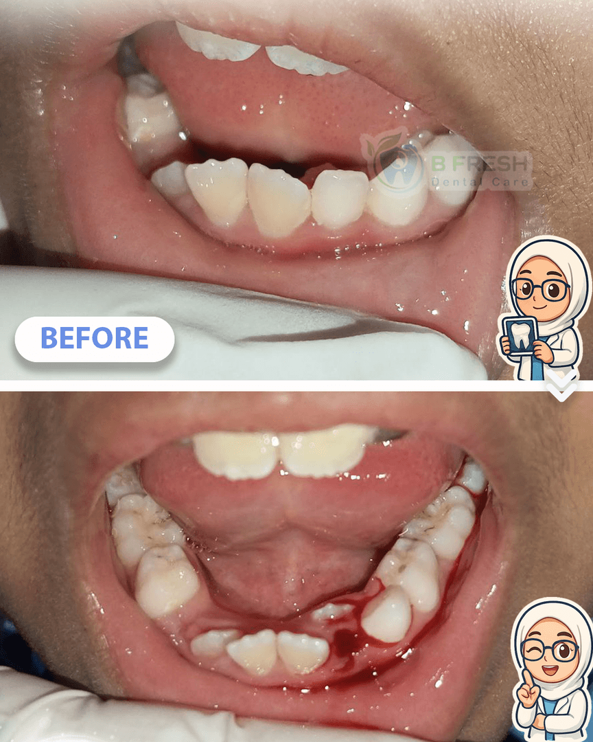 Cabut Gigi Anak #2 — hasil perawatan kasus 2 di B Fresh Dental Care