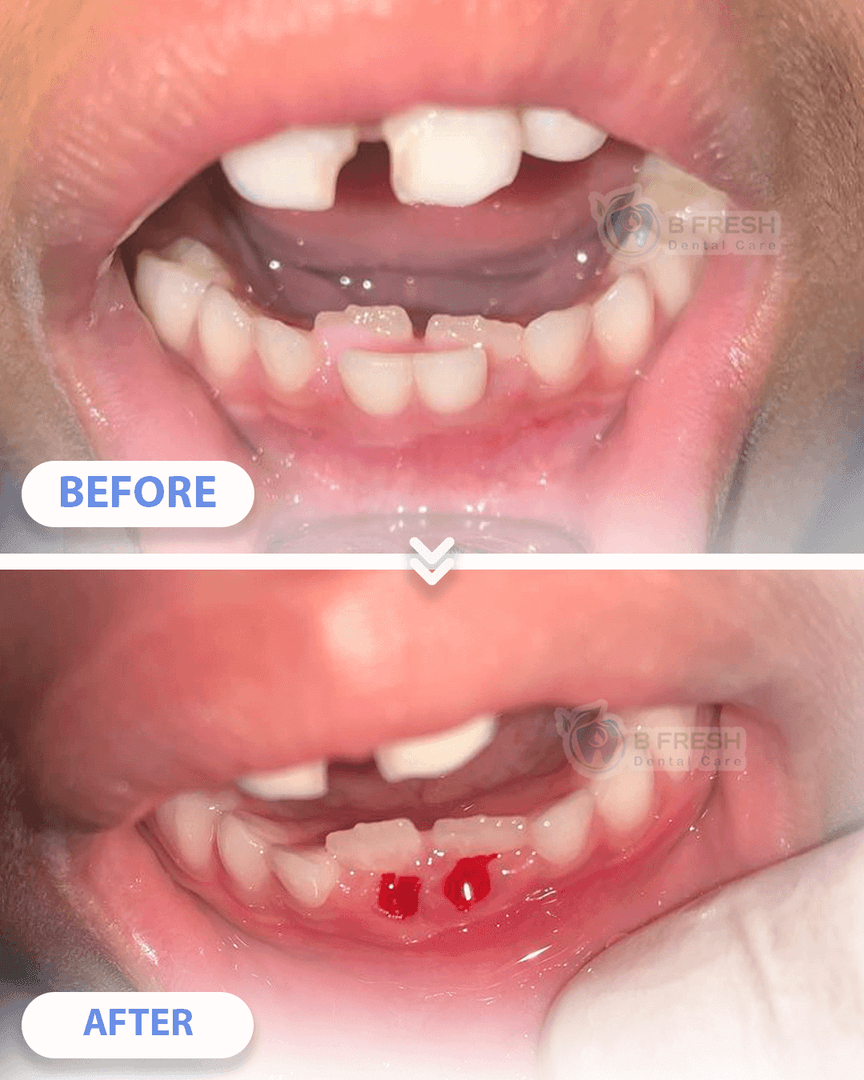Cabut Gigi Anak #2 — hasil perawatan kasus 3 di B Fresh Dental Care