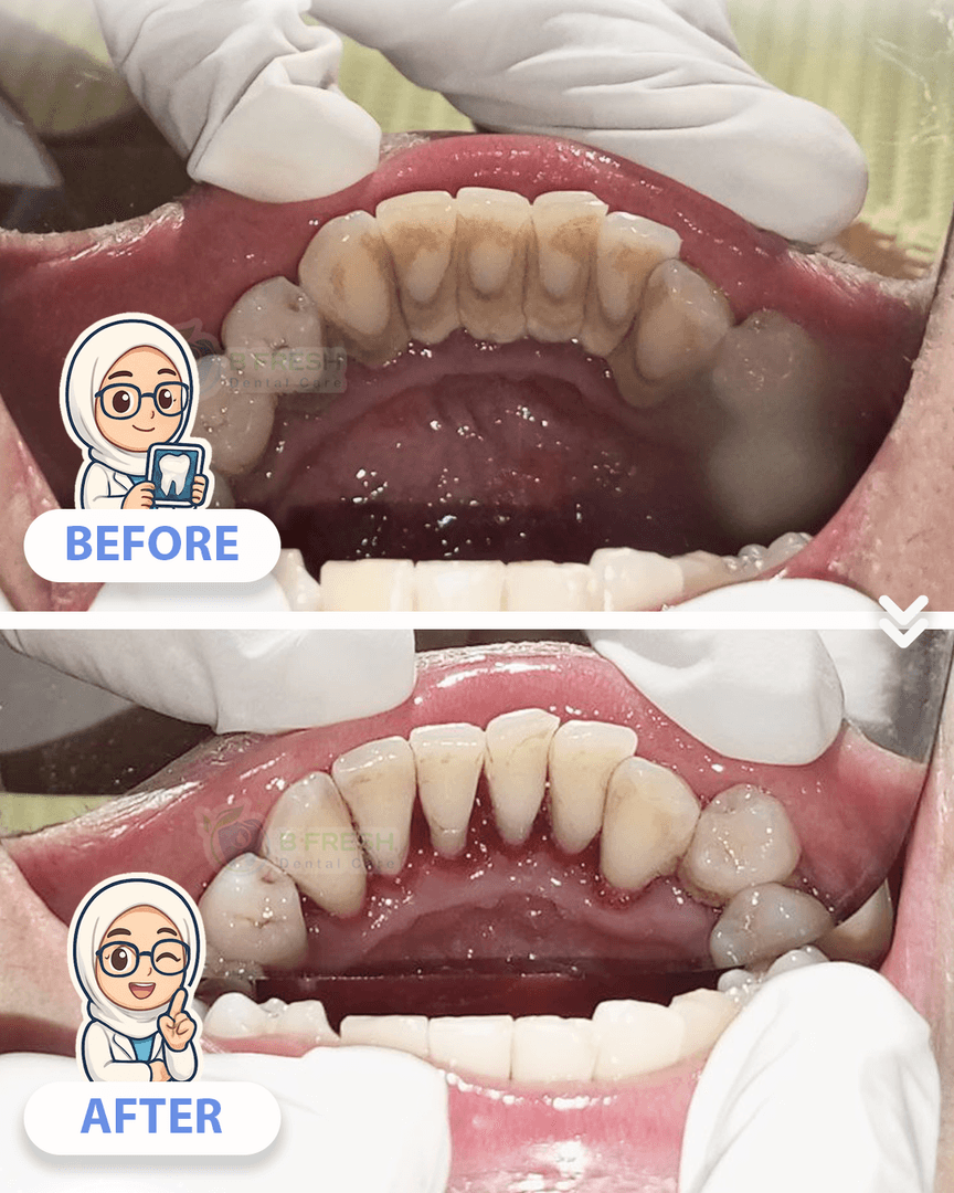Cabut Gigi Susu #1 — hasil perawatan kasus 2 di B Fresh Dental Care