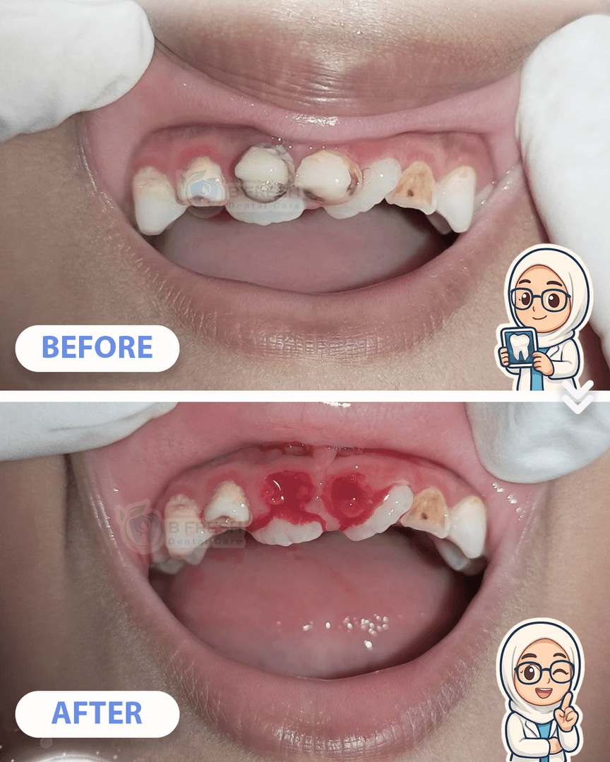 Cabut Gigi Susu #1 — hasil perawatan kasus 3 di B Fresh Dental Care