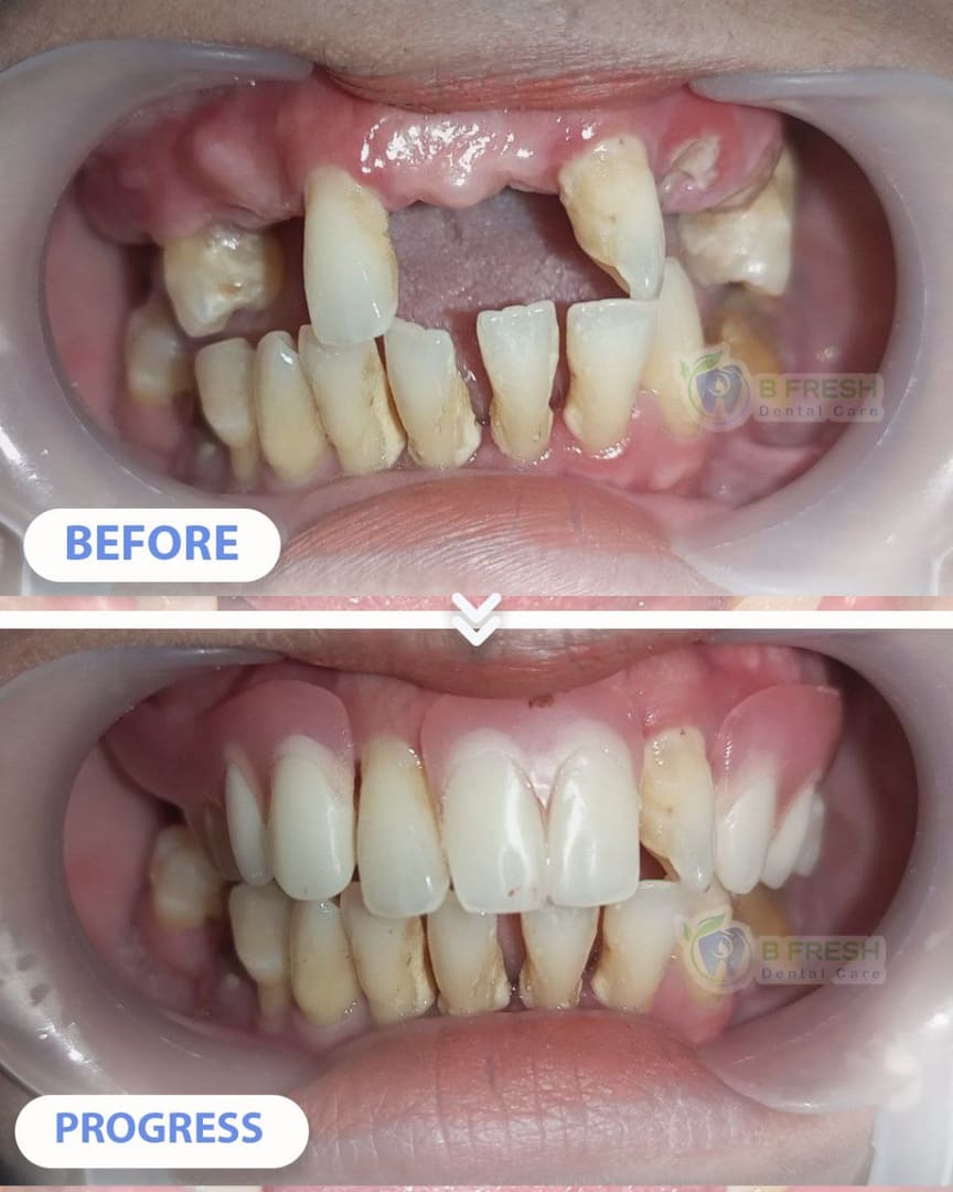 Gigi Palsu #1 — hasil perawatan kasus 3 di B Fresh Dental Care