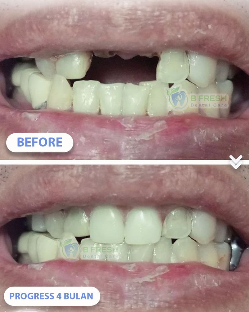 Gigi Palsu #Akrilik — hasil perawatan kasus 2 di B Fresh Dental Care