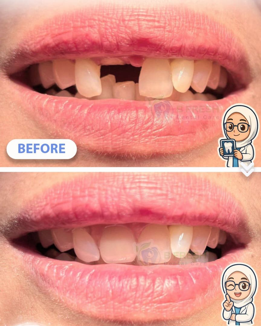 Gigi Palsu #Akrilik — hasil perawatan kasus 3 di B Fresh Dental Care