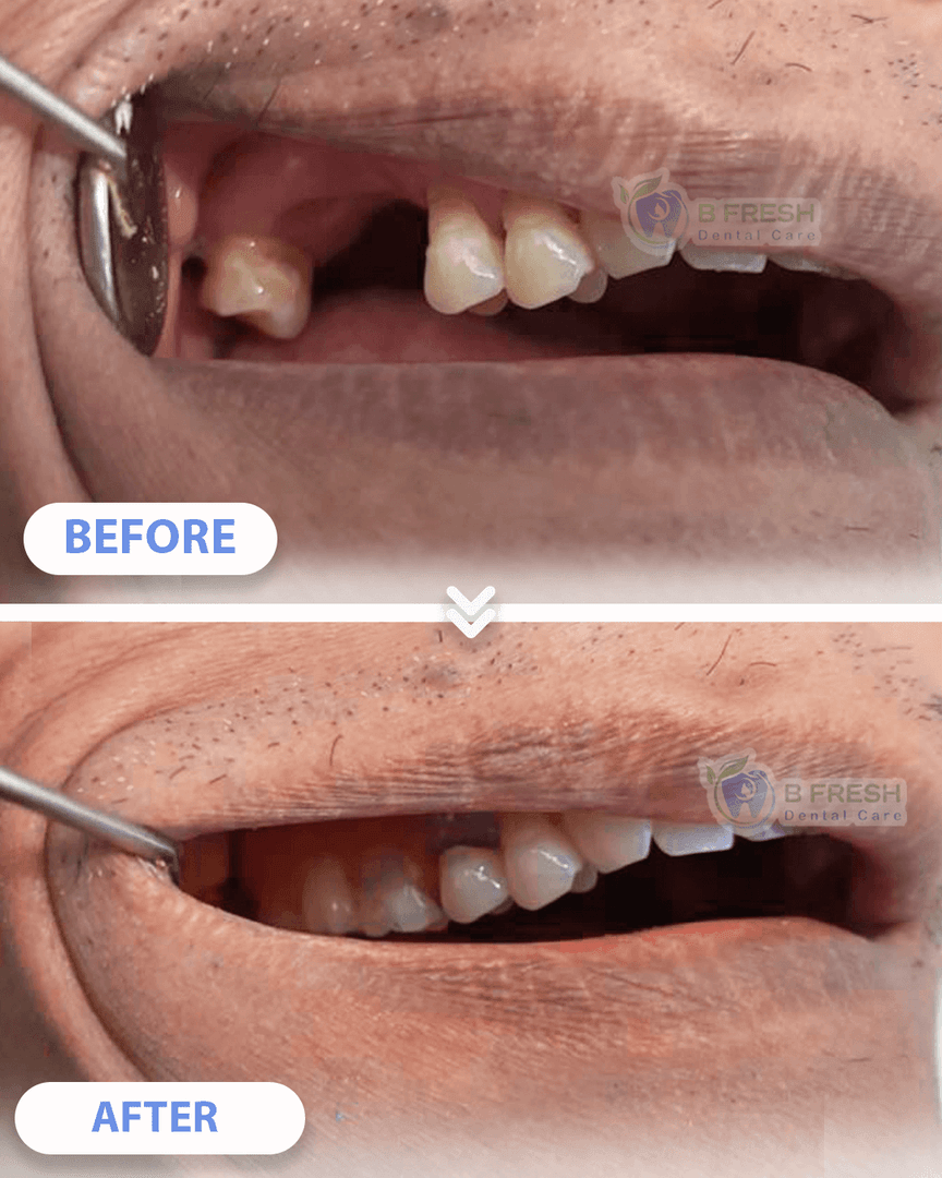 Gigi Palsu #Termosen — hasil perawatan kasus 3 di B Fresh Dental Care