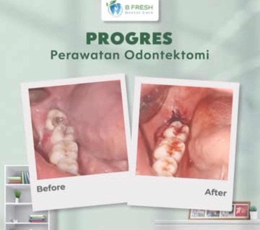 Odontektomi #1 — hasil perawatan B Fresh Dental Care