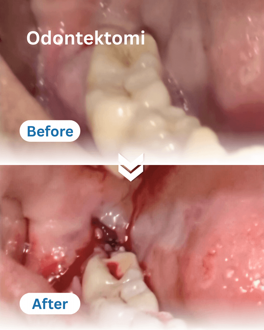 Odontektomi #2 — hasil perawatan B Fresh Dental Care