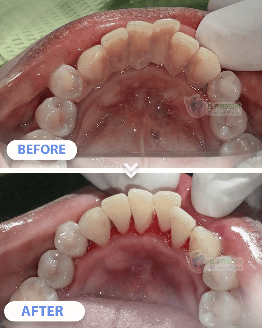 Scalling #2 — hasil perawatan kasus 2 di B Fresh Dental Care