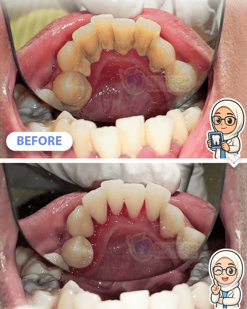 Scalling #2 — hasil perawatan kasus 3 di B Fresh Dental Care