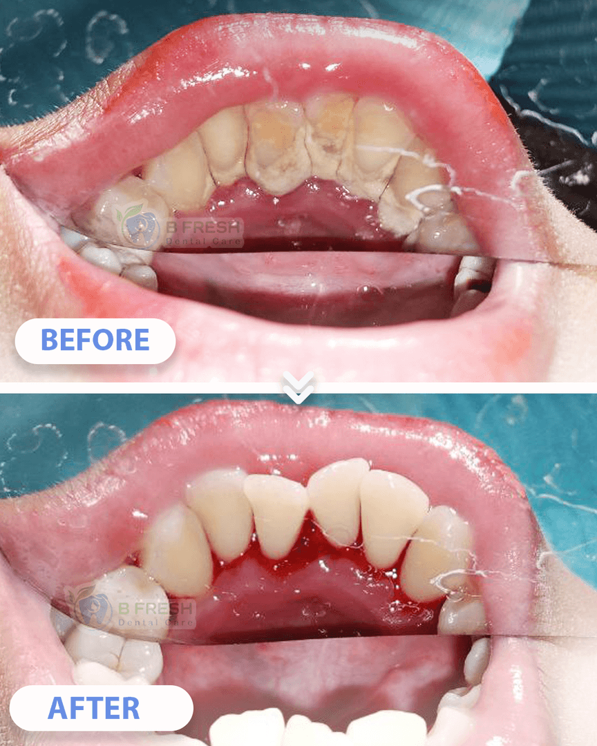 Scalling #3 — hasil perawatan kasus 3 di B Fresh Dental Care