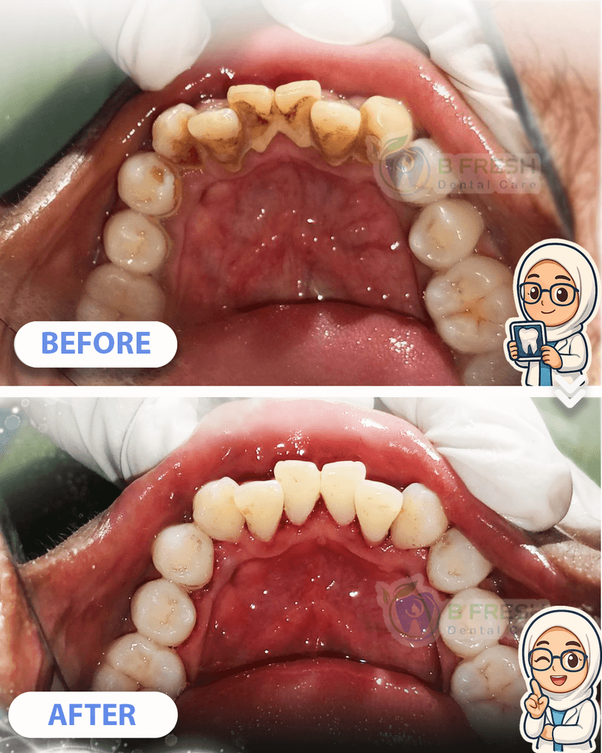 Scalling #5 — hasil perawatan kasus 3 di B Fresh Dental Care