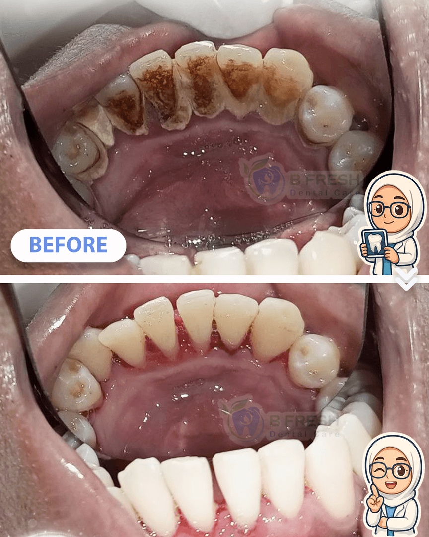 Scalling #7 — hasil perawatan kasus 3 di B Fresh Dental Care