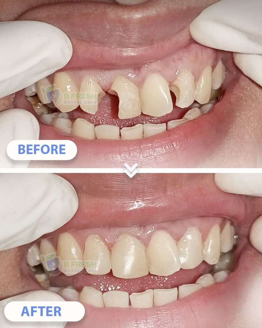 Tambal Gigi Belakang #2 — hasil perawatan kasus 2 di B Fresh Dental Care