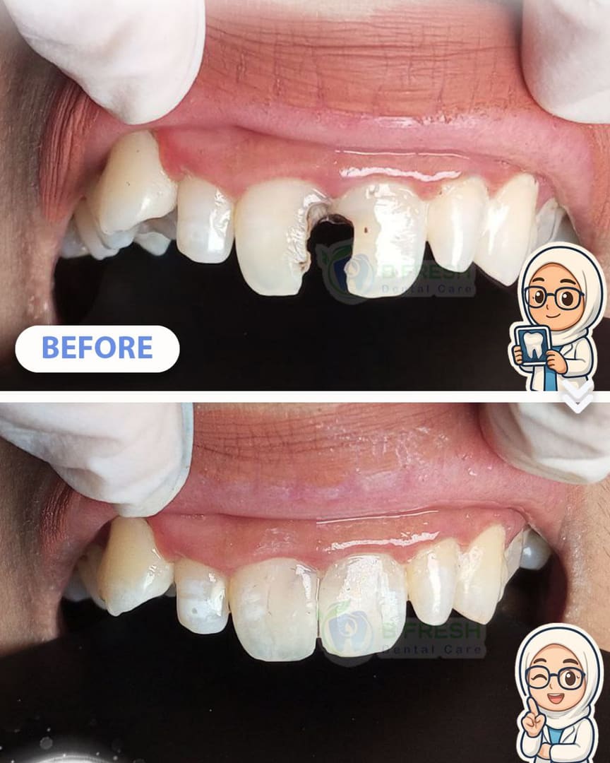 Tambal Gigi Belakang #10 — hasil perawatan kasus 3 di B Fresh Dental Care