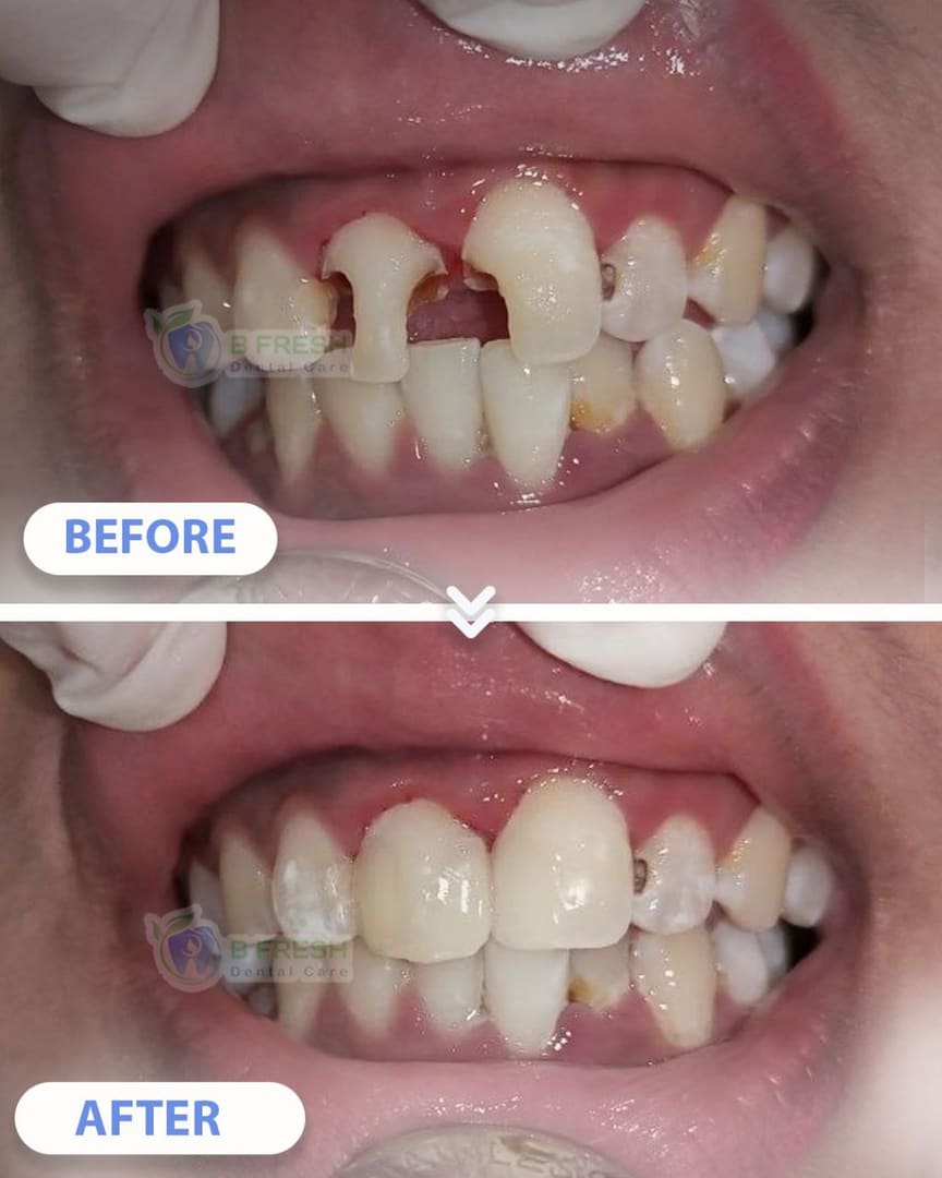 Tambal Gigi Depan #15 — hasil perawatan kasus 3 di B Fresh Dental Care