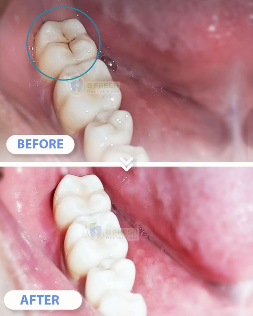 Tambal Gigi Belakang #16 — hasil perawatan B Fresh Dental Care