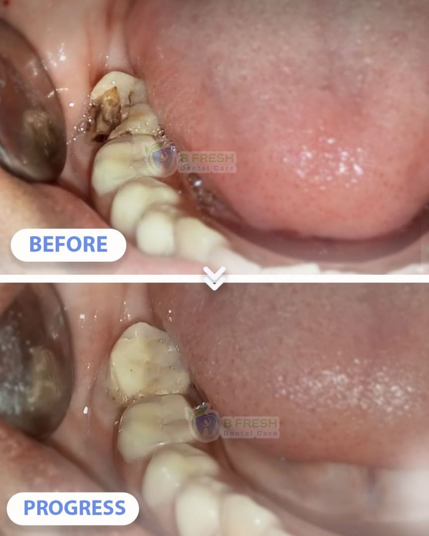 Tambal Gigi Belakang #16 — hasil perawatan kasus 3 di B Fresh Dental Care