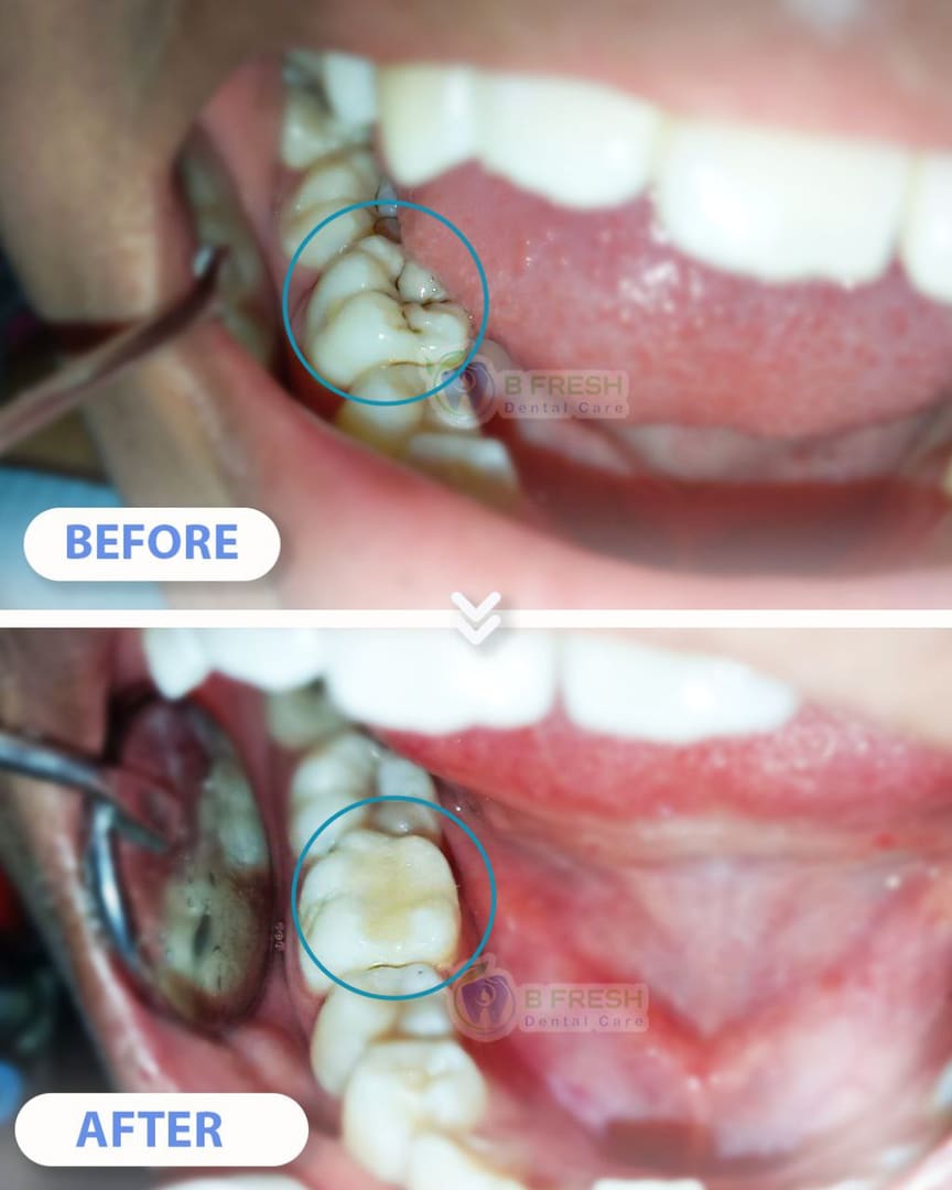 Tambal Gigi Belakang #17 — hasil perawatan kasus 1 di B Fresh Dental Care