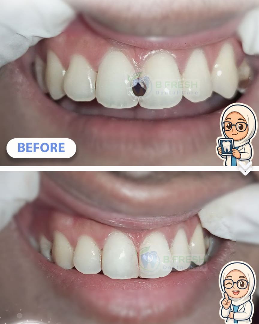 Tambal Gigi Depan #20 — hasil perawatan kasus 1 di B Fresh Dental Care