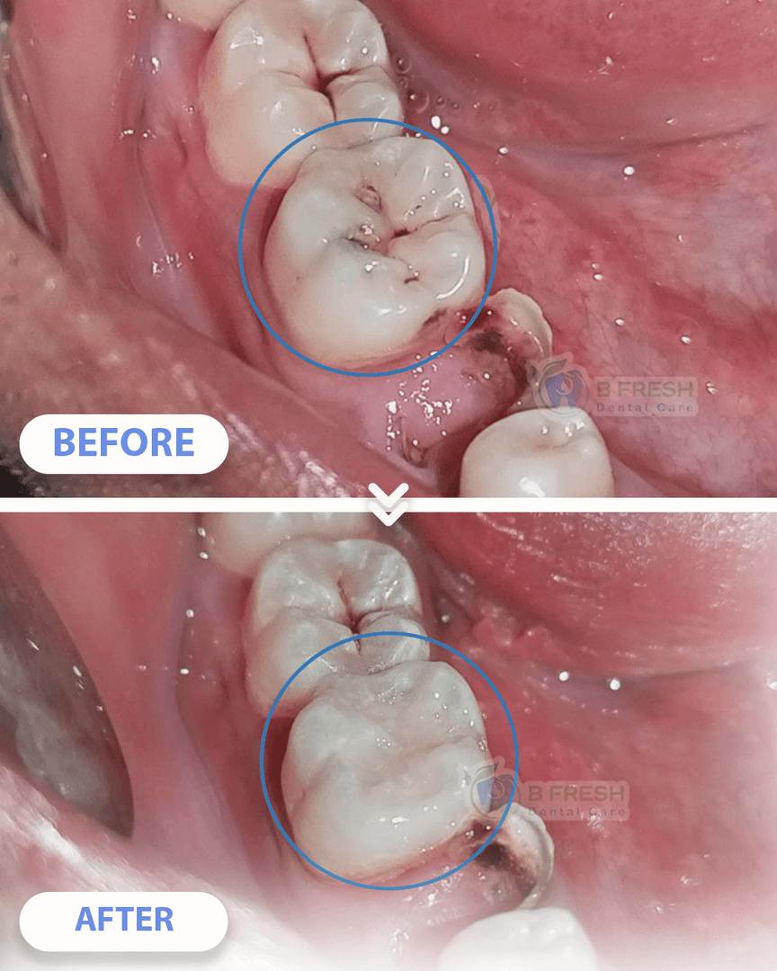Tambal Gigi Depan #20 — hasil perawatan kasus 2 di B Fresh Dental Care