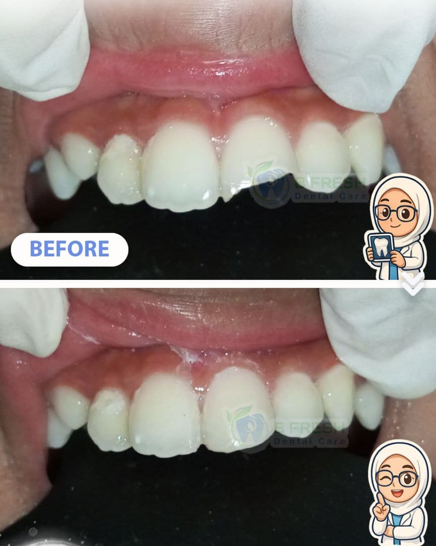 Tambal Gigi Depan #22 — hasil perawatan kasus 1 di B Fresh Dental Care
