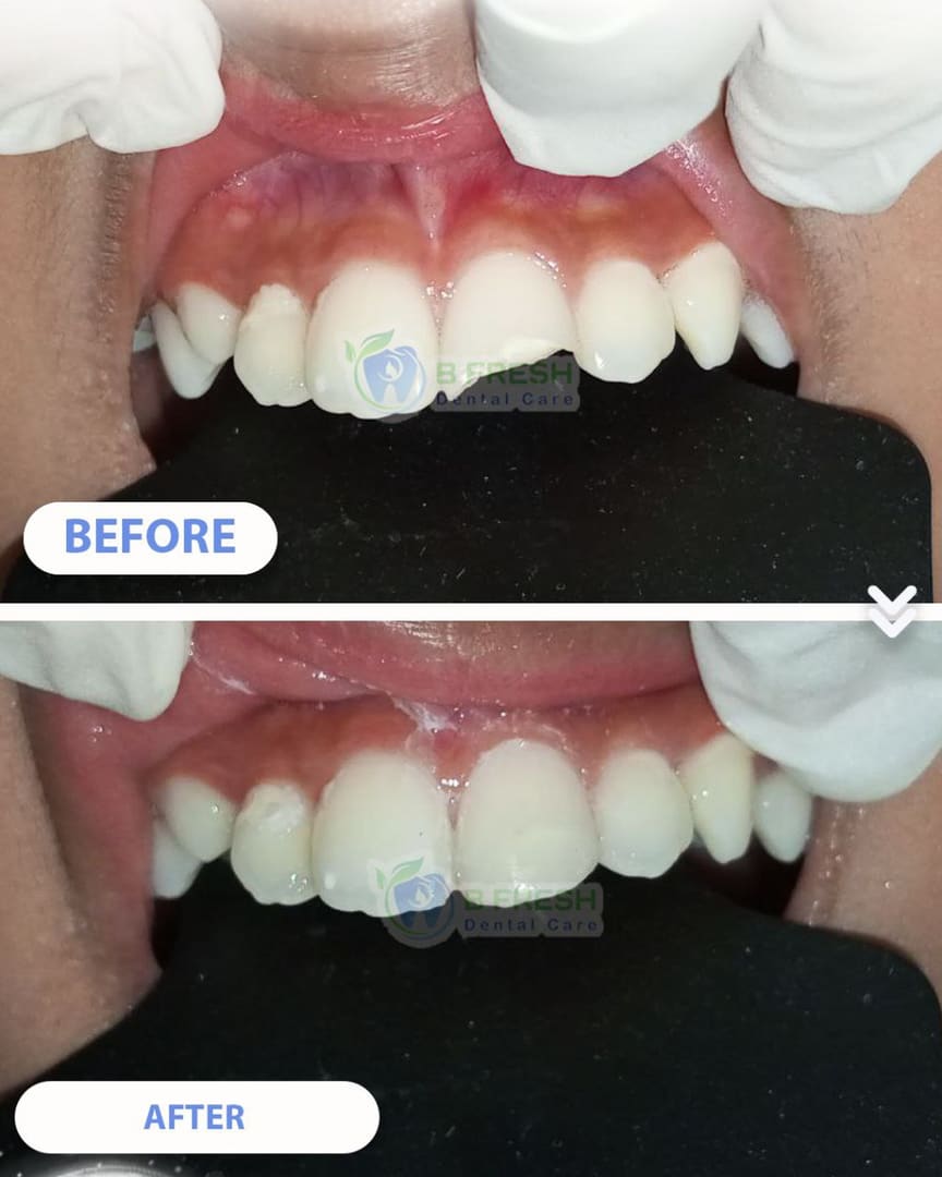 Tambal Gigi Depan #22 — hasil perawatan kasus 3 di B Fresh Dental Care