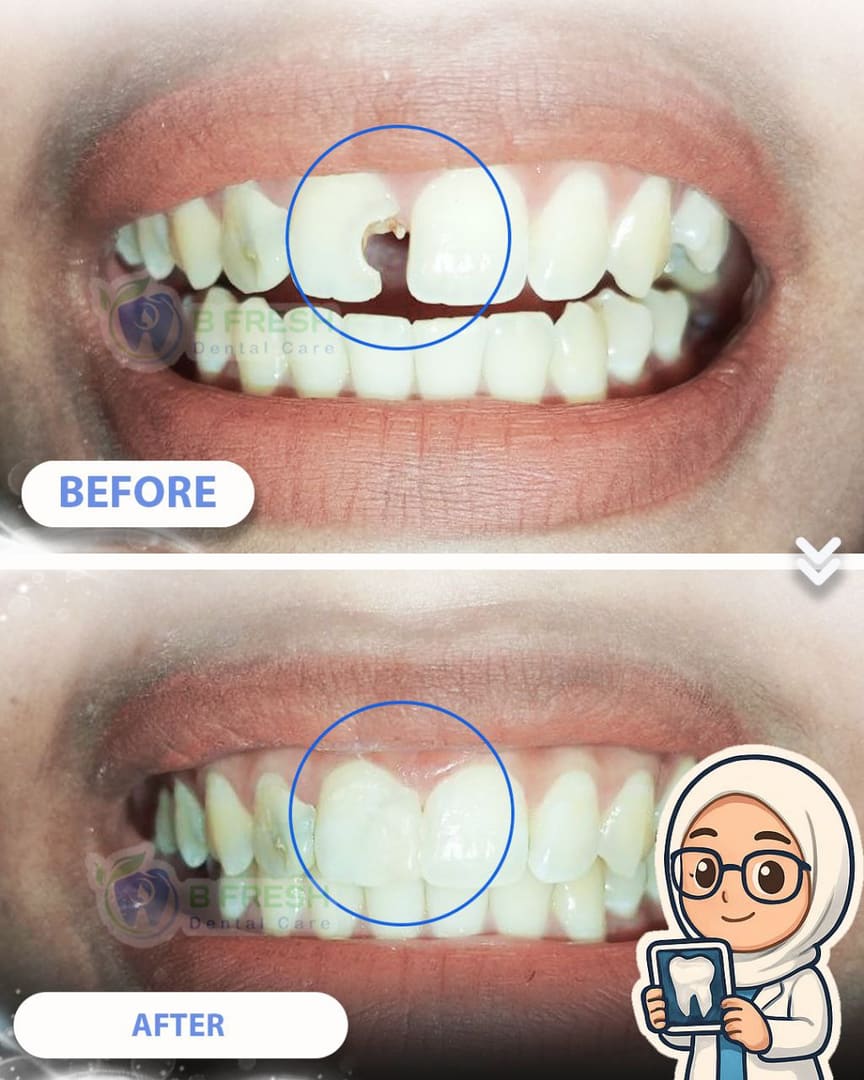 Tambal Gigi Belakang #23 — hasil perawatan kasus 3 di B Fresh Dental Care