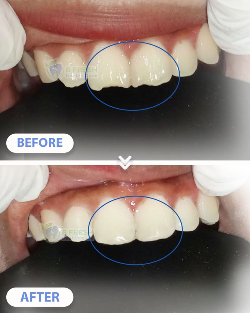 Tambal Gigi Depan #24 — hasil perawatan kasus 3 di B Fresh Dental Care
