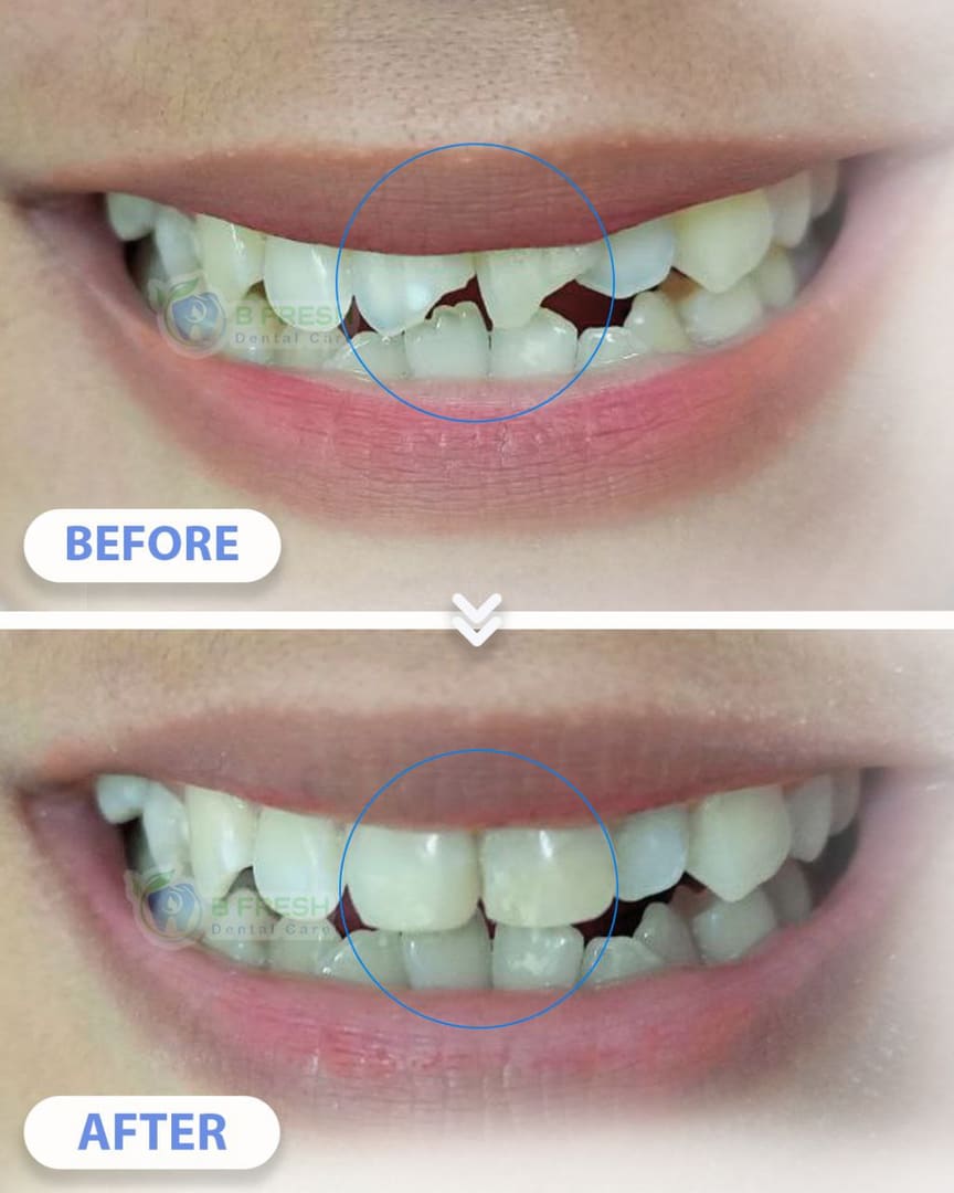 Tambal Gigi Belakang #25 — hasil perawatan kasus 3 di B Fresh Dental Care