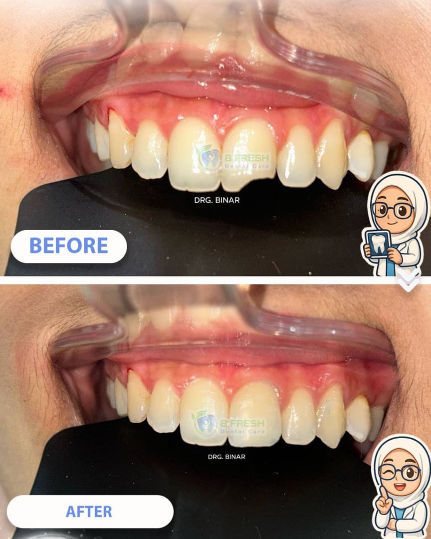 Tambal Gigi Depan #26 — hasil perawatan kasus 1 di B Fresh Dental Care