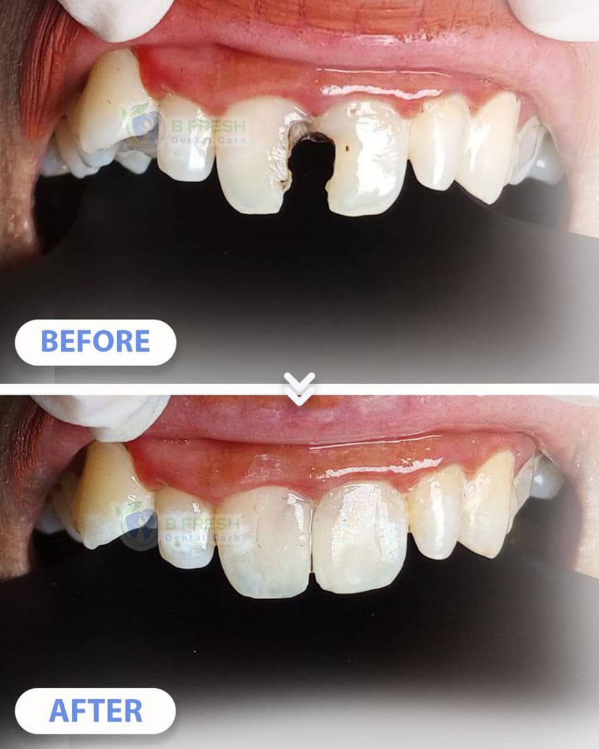 Tambal Gigi Depan #3 — hasil perawatan kasus 3 di B Fresh Dental Care