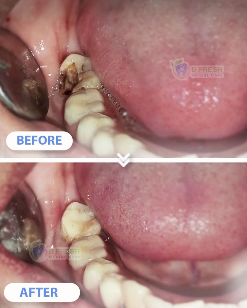 Tambal Gigi Depan #7 — hasil perawatan kasus 3 di B Fresh Dental Care