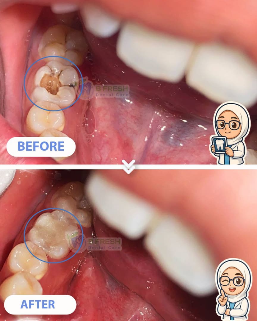 Tambal Gigi Belakang #8 — hasil perawatan kasus 3 di B Fresh Dental Care
