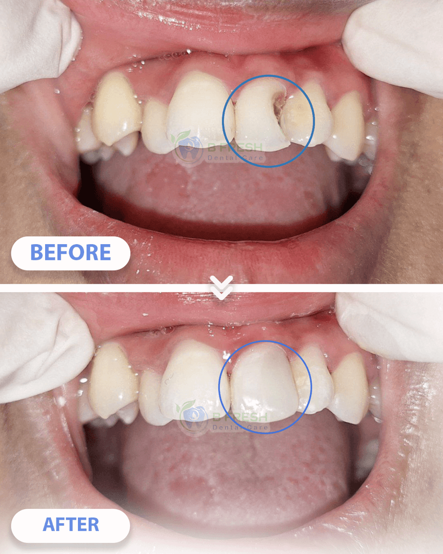 Tambal Gigi Depan #1 — hasil perawatan kasus 1 di B Fresh Dental Care