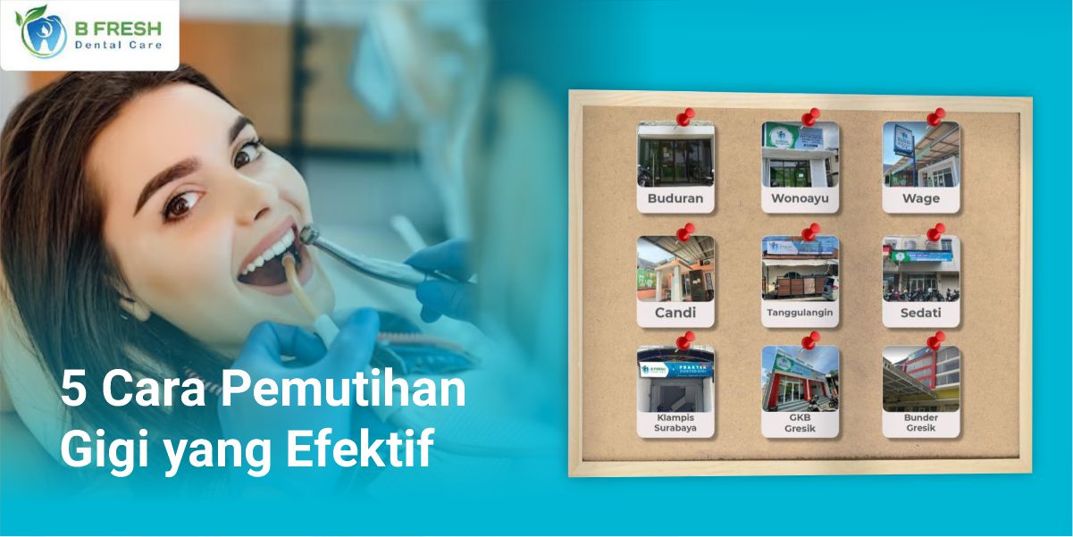 5 Cara Pemutihan Gigi Yang Efektif
